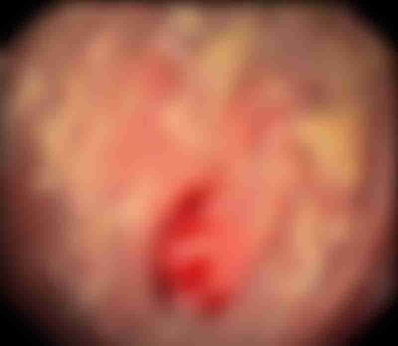 Atrophic Gastritis and Tumor